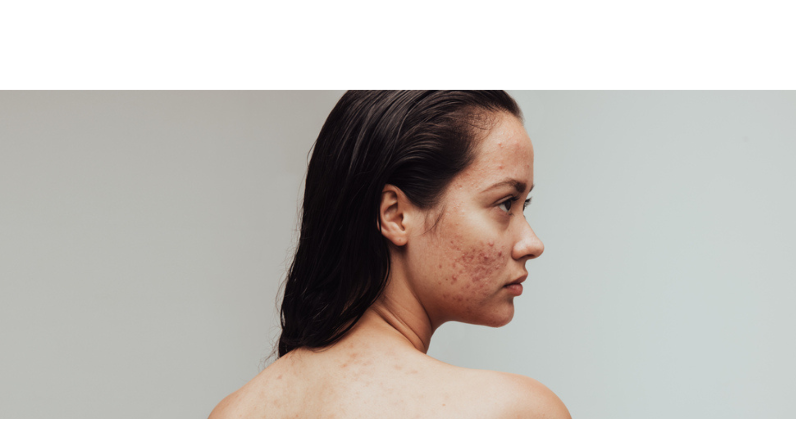 Erase Acne Scars: Smooth Skin Treatments