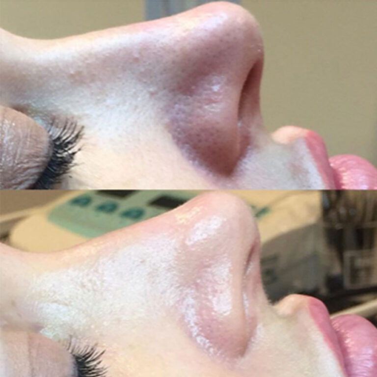 Ameson Mesopeel Chemical Peels: Rejuvenate Your Skin